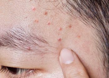 Cara Menghilangkan Jerawat