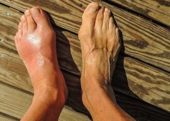 Obat Asam Urat Alami