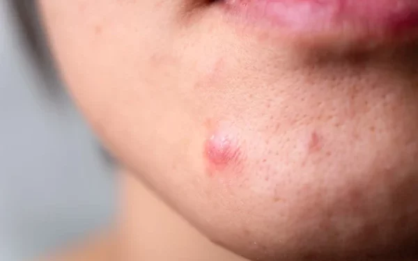 Jerawat Batu : Penyebab dan Cara Mengobatinya