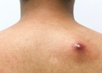 Cara Mengatasi Bisul yang Meradang Secara Alami