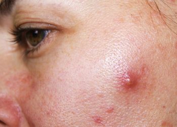 Cara Menghilangkan Jerawat Batu Secara Alami