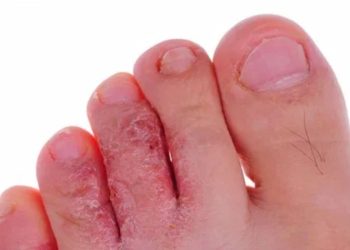 Kutu Air dan Cara Mengobatinya