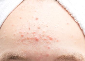 Cara Menghilangkan Jerawat