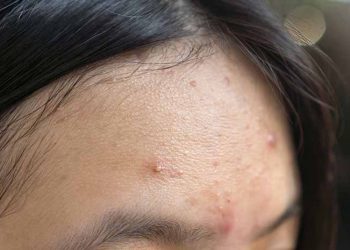 5 Kandungan Skincare yang Ampuh Atasi Bruntusan