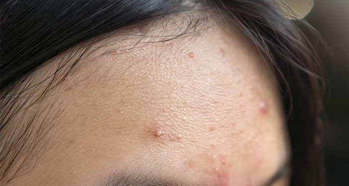 5 Kandungan Skincare yang Ampuh Atasi Bruntusan