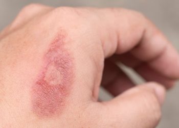 6 Tips Mengatasi Luka Bakar Ringan Secara Tepat
