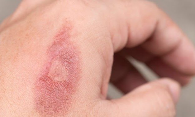 6 Tips Mengatasi Luka Bakar Ringan Secara Tepat