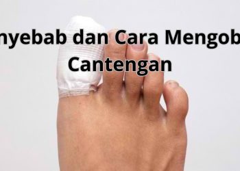 Penyebab dan Cara Mengatasi Kuku Kaki yang Masuk ke Daging (Cantengan)