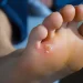 Penyebab dan Cara Mengatasi Mata Ikan di Telapak Kaki