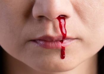 Penyebab dan Cara Mengatasi Mimisan
