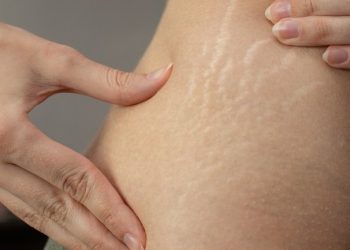 Penyebab dan Cara Mengatasi Stretch Mark