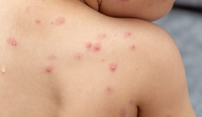 Cacar Air: Pahami Gejala, Penyebab, dan Cara Mengatasi