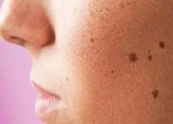 Cara Efektif Mengatasi Flek Hitam di Wajah Secara Alami
