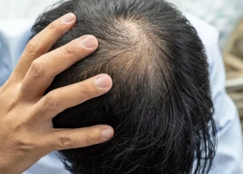 Ketahui Penyebab Rambut Rontok dan Cara Mengatasinya