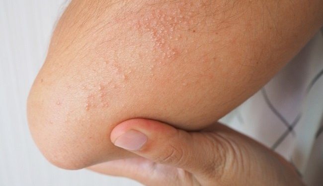 Penyebab dan Cara Mengatasi Biang Keringat Secara Efektif