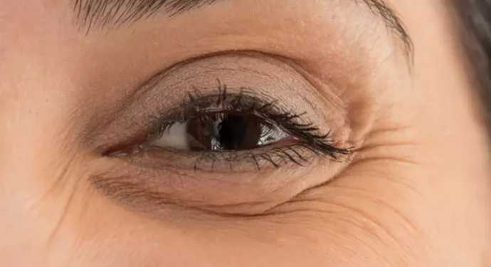 Penyebab dan Cara Mengatasi Keriput di Bawah Mata