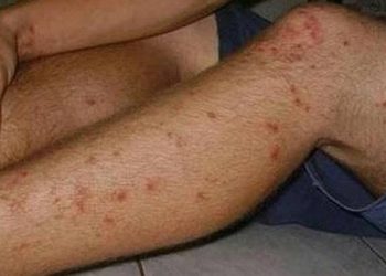 Penyebab dan Cara Mengatasi Koreng (Bekas Luka) di Kaki