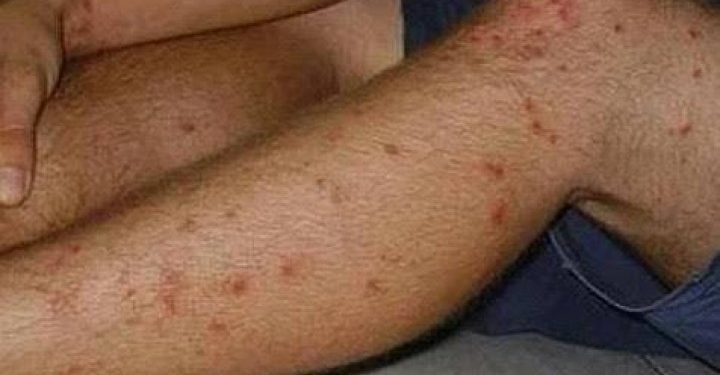 Penyebab dan Cara Mengatasi Koreng (Bekas Luka) di Kaki