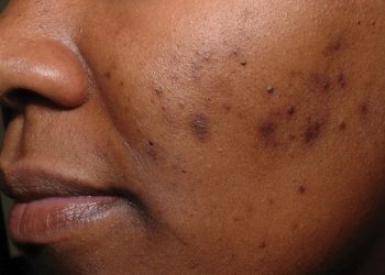 Cara Menghilangkan Noda Hitam Bekas Jerawat