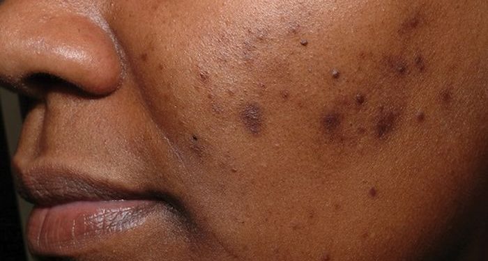 Cara Menghilangkan Noda Hitam Bekas Jerawat