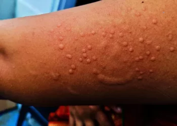 Apa Itu Cacar Monyet? Berikut Penyebab dan Gejalanya