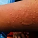 Apa Itu Cacar Monyet? Berikut Penyebab dan Gejalanya