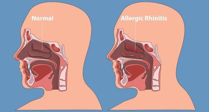 Apa Itu Rhinitis? Berikut Definisi dan Penyebabnya