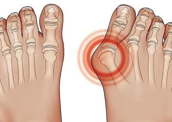 Penyebab Asam Urat yang Sering Kambuh: Kenali Faktor dan Cara Mengatasinya