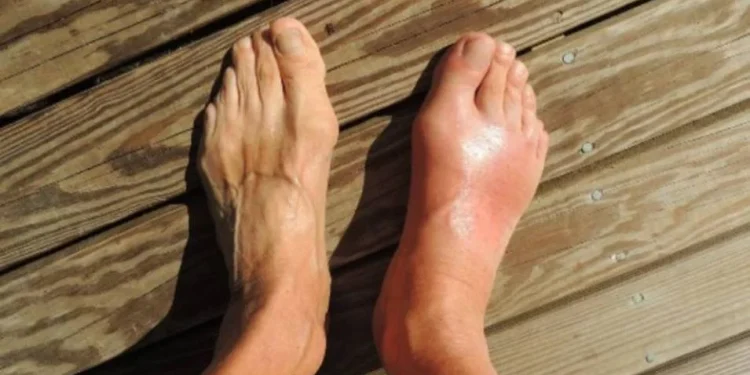 Dampak Asam Urat yang Perlu Diwaspadai