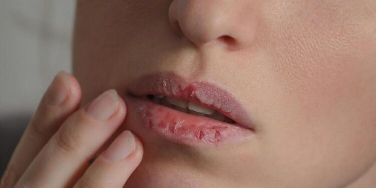 Cara Efektif Mengatasi Bibir Kering: Tips agar Bibir Tetap Lembap dan Sehat