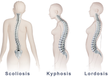 Apa Itu Lordosis? Ini Pengertian dan Penyebabnya