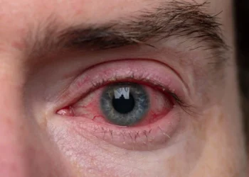 Apa Itu Konjungtivitis? Ini Ciri-Ciri dan Penyebab Mata Merah