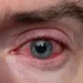 Apa Itu Konjungtivitis? Ini Ciri-Ciri dan Penyebab Mata Merah