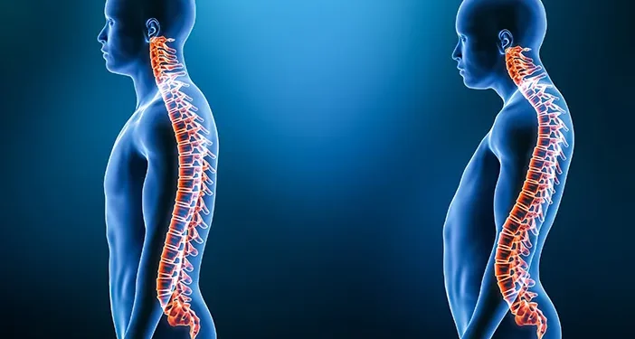 Jenis-Jenis Lordosis yang Sering Terjadi, Ini Penjelasan Lengkapnya