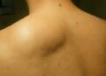 Lipoma: Pengertian, Penyebab, dan Gejala