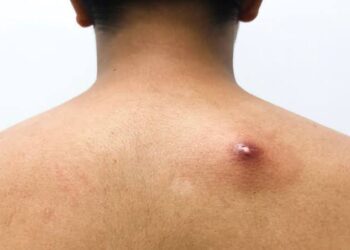 Apa Itu Abses? Ini Pengertian, Penyebab, dan Jenisnya