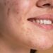 Apa Itu Fungal Acne? Ini Pengertian dan Gejalanya