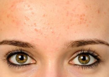 Apa Penyebab Fungal Acne? Kenali Faktor Pemicunya