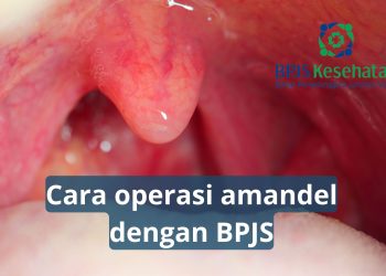 Cara Operasi Amandel Dengan BPJS
