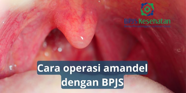 Cara Operasi Amandel Dengan BPJS