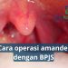 Cara Operasi Amandel Dengan BPJS