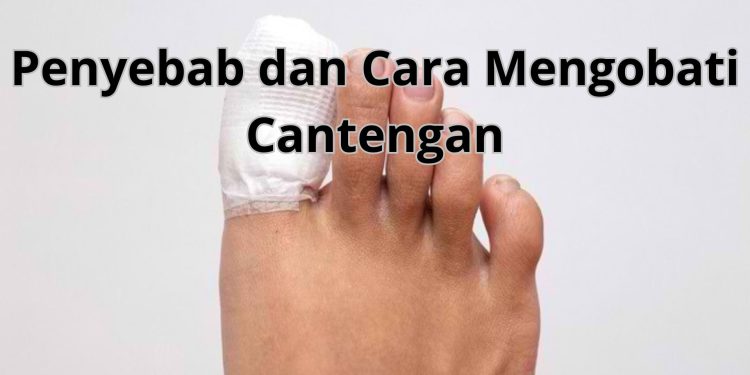 Cantengan: Penyebab, Gejala, dan Cara Mengatasi