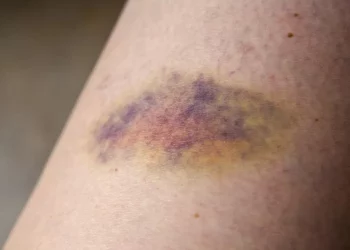 Mengobati Memar Secara Alami: Tips dan Trik yang Efektif