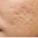 10 Cara Mengatasi Bekas Jerawat Secara Alami