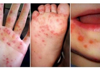 Cek Ini Perbedaan Gejala Flu Biasa dan Flu Singapura