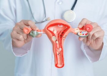 Penyebab Kista Ovarium Bagi Wanita Dan Cara Mengatasi Dan Mengobatinya