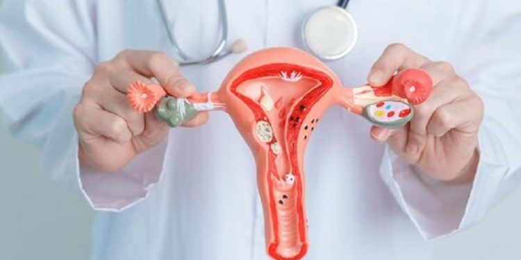 Penyebab Kista Ovarium Bagi Wanita Dan Cara Mengatasi Dan Mengobatinya