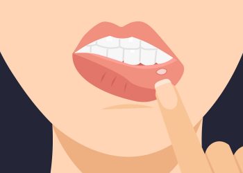 Sariawan Sering Muncul Saat Puasa? Begini Tips Mengatasi dan Mencegahnya