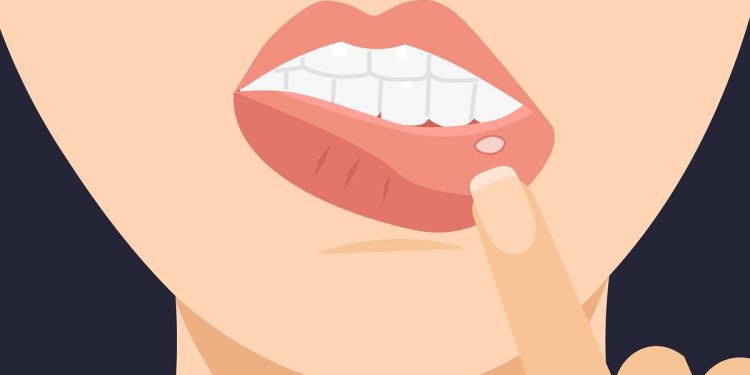 Sariawan Sering Muncul Saat Puasa? Begini Tips Mengatasi dan Mencegahnya