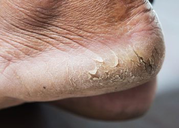 Ini Obat Kaki Pecah - Pecah Secara Alami dan Ampuh